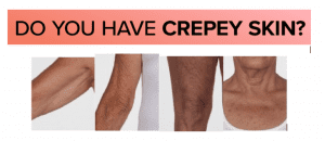 Read more about the article People With Crepey Skin in Los Angeles for TV Commercial