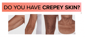 Read more about the article People With Crepey Skin in Los Angeles for TV Commercial