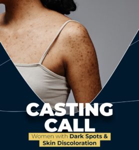 Read more about the article Casting People in Los Angeles with Dark Spots on Skin for Paid Promo